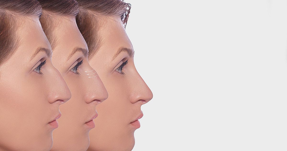 Nasenhöcker entfernen: Was Sie vor, während und nach dem Eingriff wissen müssen