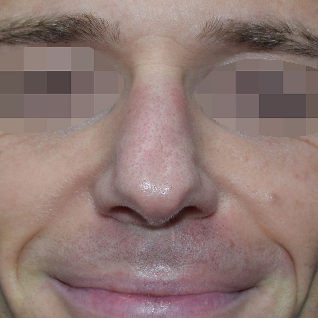 Nasenkorrektur Vorher